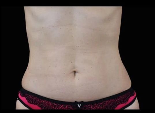 After Emsculpt Neo · Abdomen