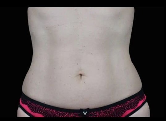 Before Emsculpt Neo · Abdomen
