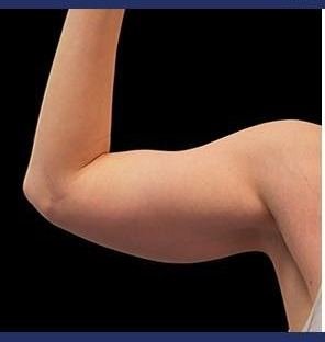 Before Emsculpt Neo · Arms