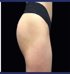 After Emsculpt Neo · Buttocks