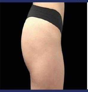 Before Emsculpt Neo · Buttocks