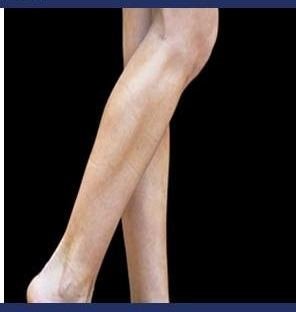 Emsculpt Neo result: Calves