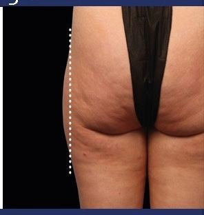 Emsculpt Neo result: Thighs
