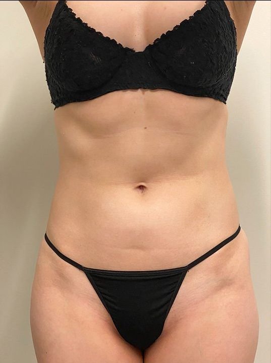 Emsculpt Neo result: Love handles
