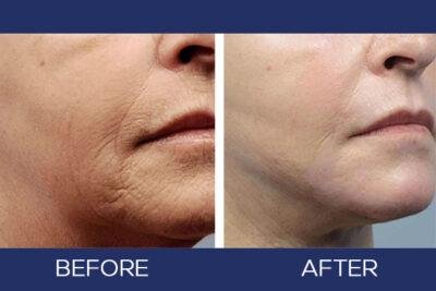 Fractional Resurfacing