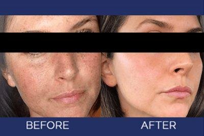 Facial Treatment - Before and After