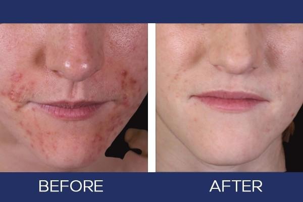 Eczema-Eczema-Before-and-After (1)