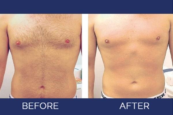 laser-hair-removal-new