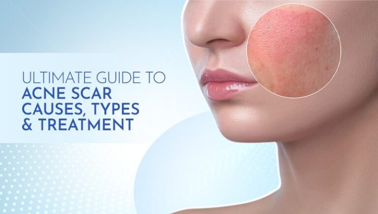 Acne Scar Guide: Causes, Types, and Effective Treatments