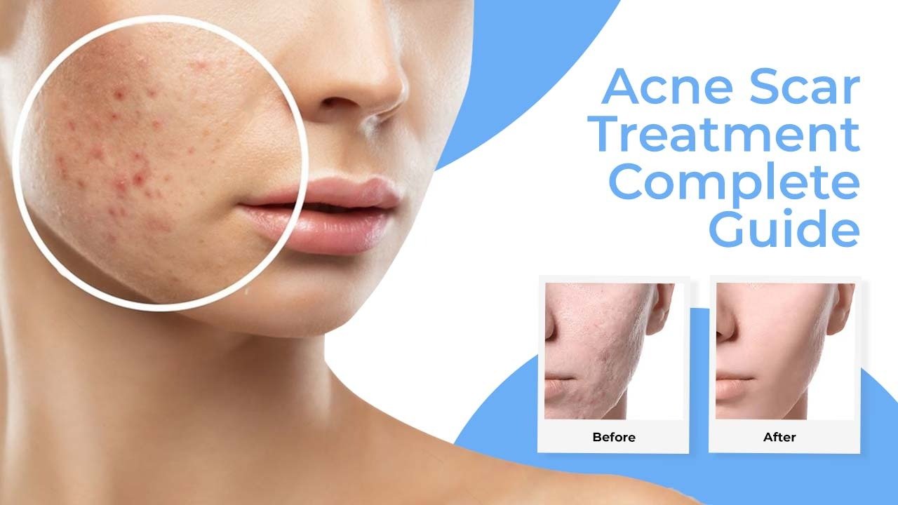 Acne Scar Treatment - Complete Guide