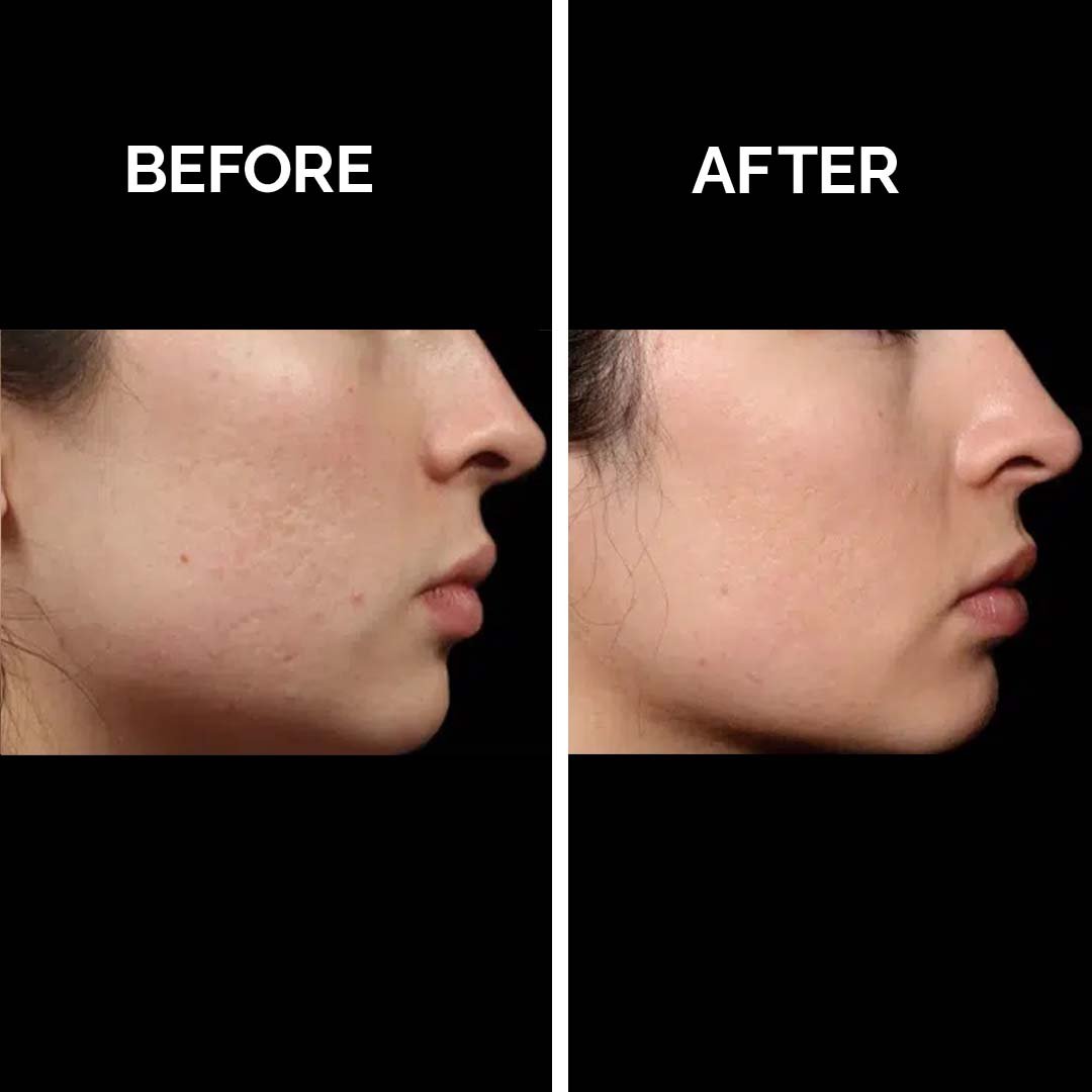 Active Acne Treatment copy 4