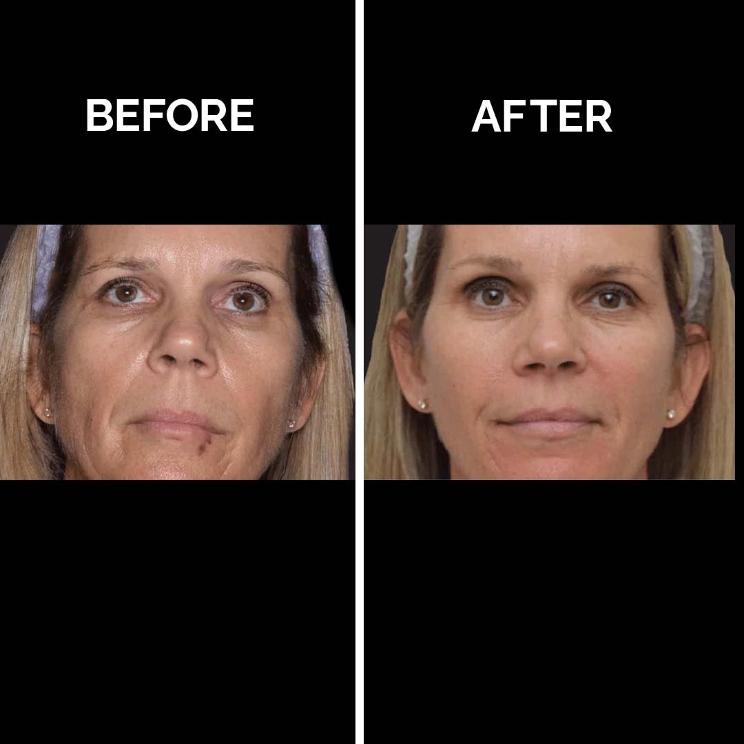 Active Acne Treatment copy