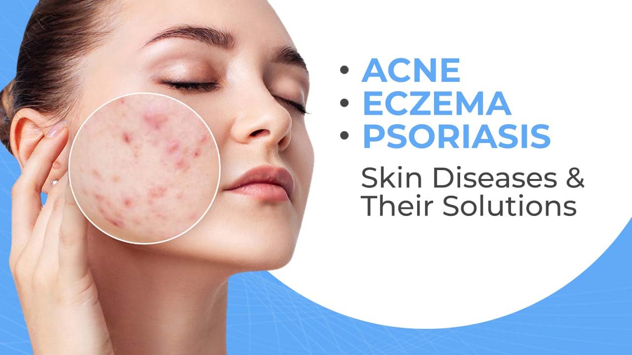 ACNE, ECZEMA, PSORIASIS