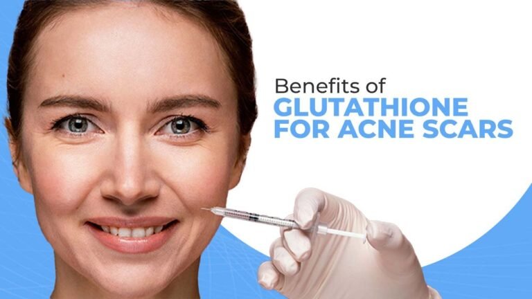 Benefits of Glutathione for Acne Scars