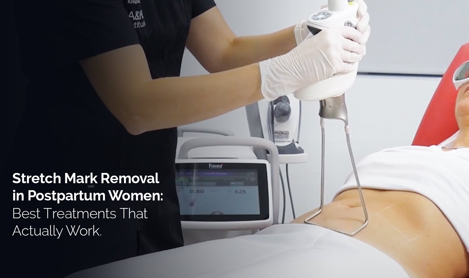 Stretch Mark Removal in Postpartum Women: Best Treatments That Actually Work