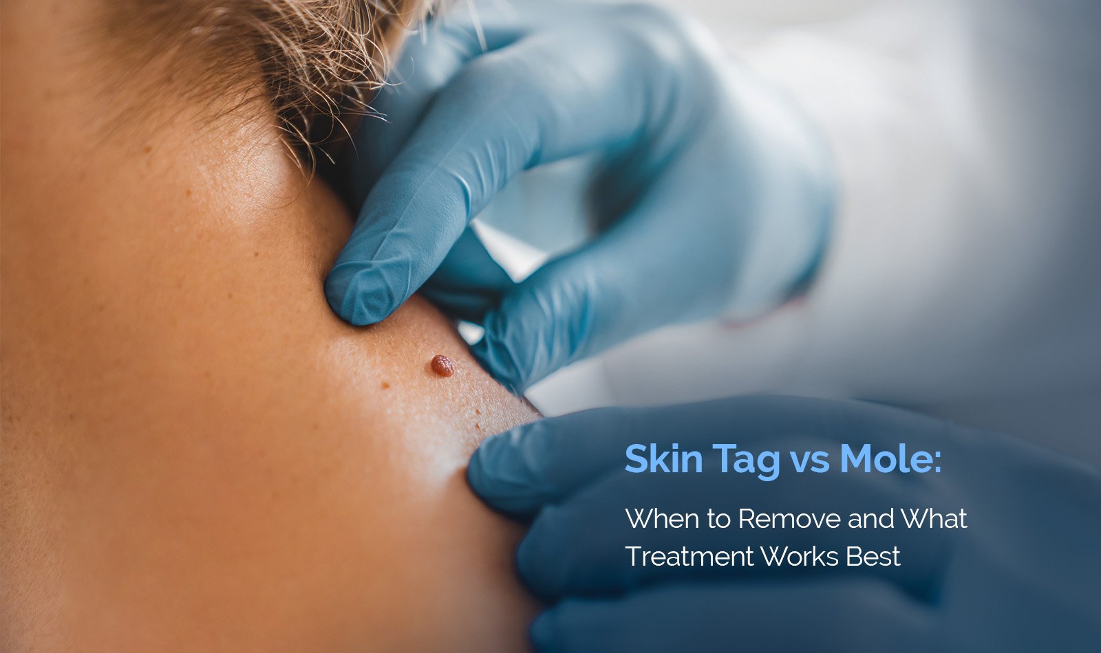 Skin Tag vs Mole: When to Remove and What Treatment Works Best