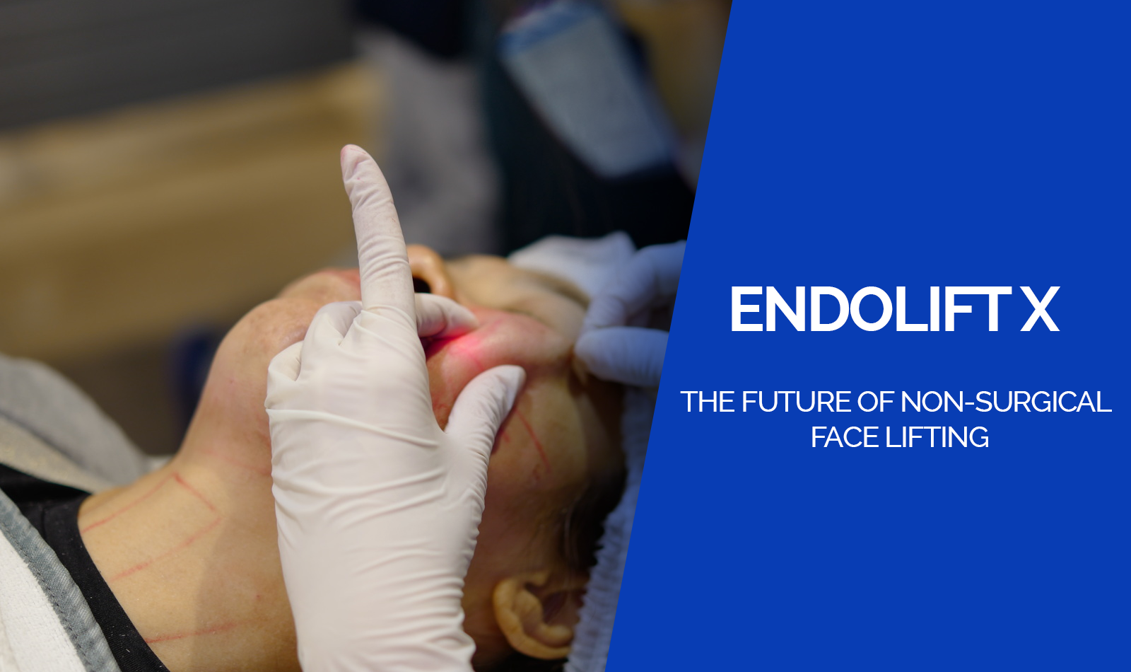 Endolift X: The Future of Non-Surgical Face Lifting