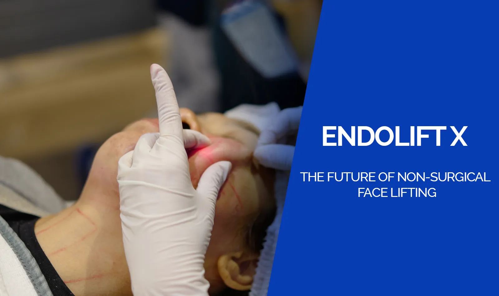 Endolift X: The Future of Non-Surgical Face Lifting