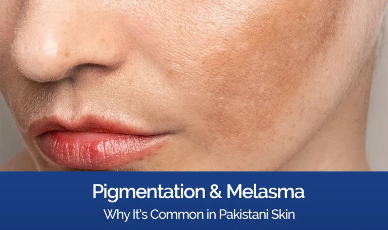 Pigmentation and Melasma: Why It Is Common in Pakistani Skin