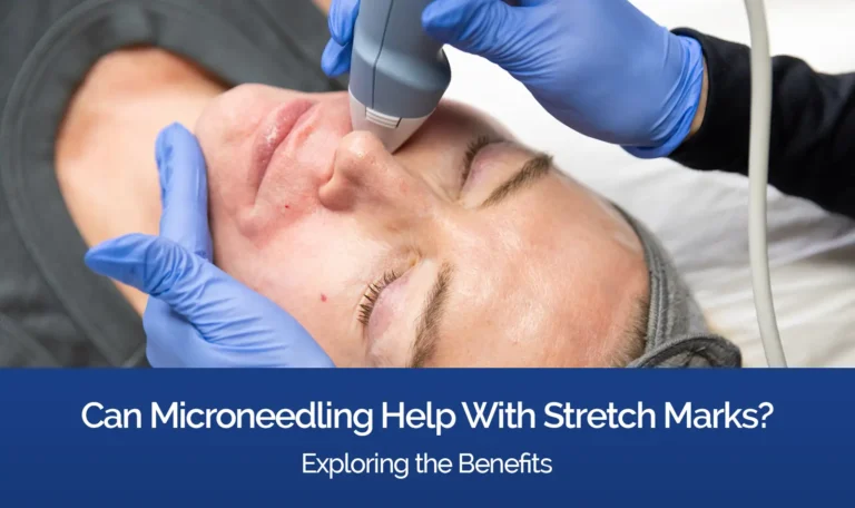 Can Microneedling Help With Stretch Marks? Exploring the Benefits
