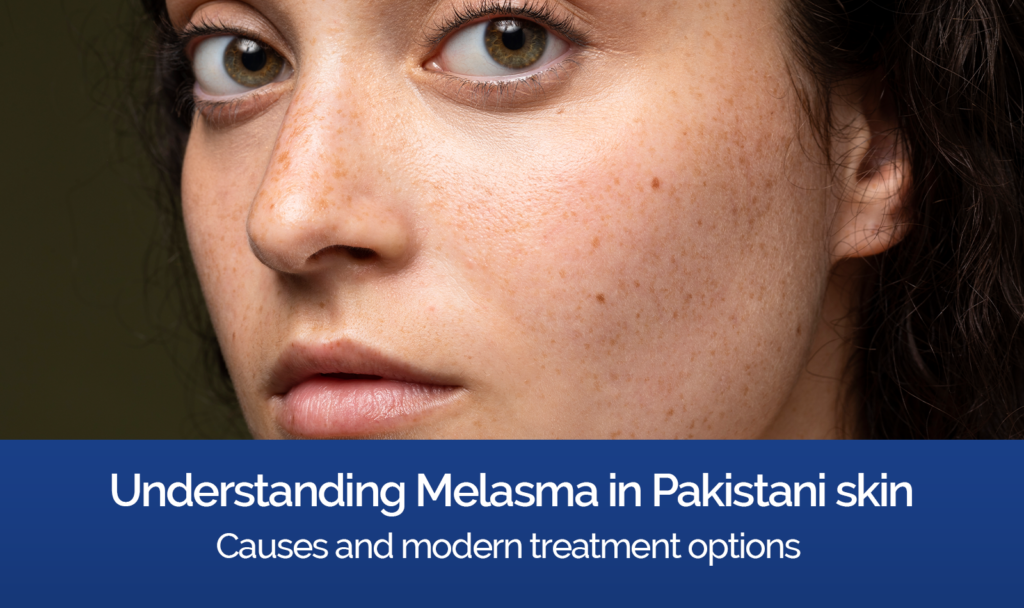Melasma treatment in Karachi