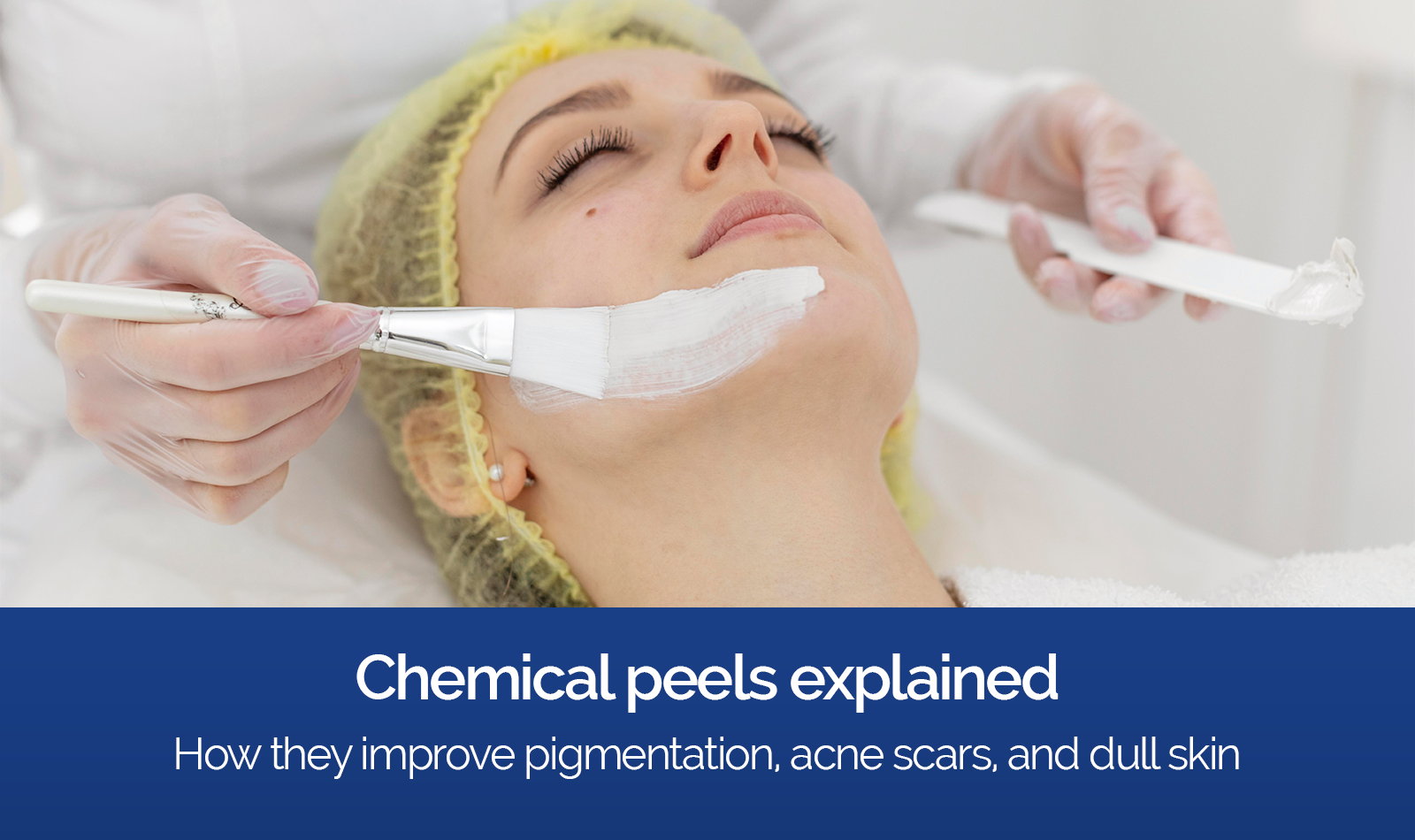 Chemical peel treatment