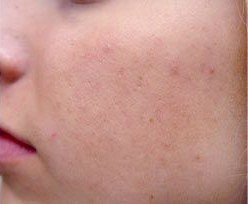 After Laser Treatment for Active Acne