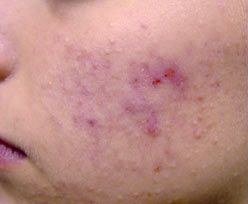 Before Laser Treatment for Active Acne