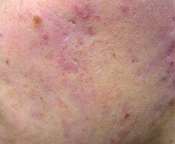 Laser Treatment for Active Acne result: Cheek, severe