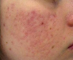 Laser Treatment for Active Acne result: Jaw and cheek