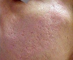 After Acne Scar Removal
