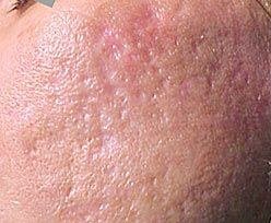 Before Acne Scar Removal