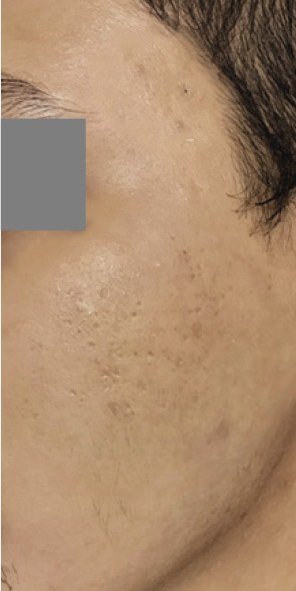 Acne Scar Removal result: Scars and marks