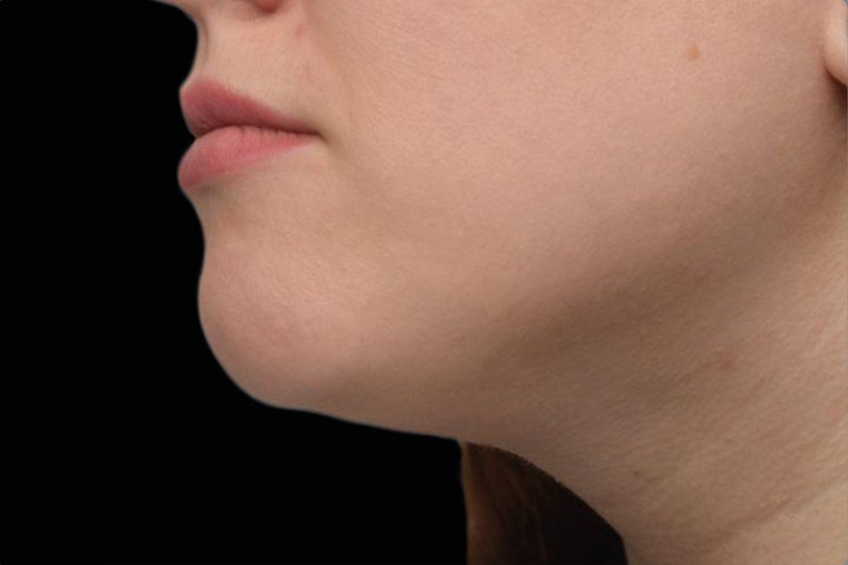 After Emface · Under the chin