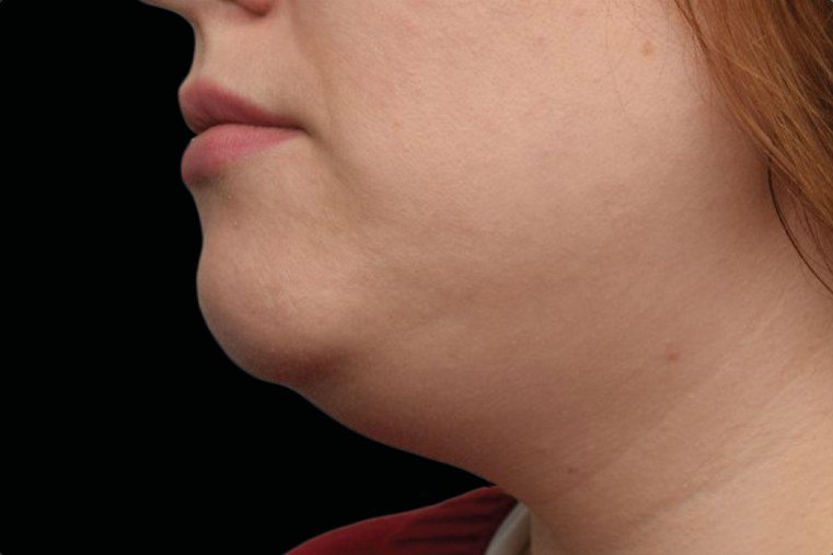 Before Emface · Under the chin