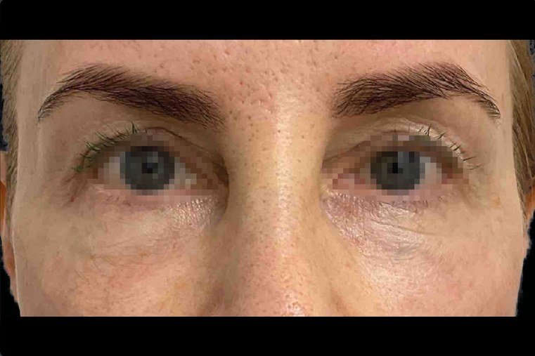 Emface result: Brows and eyes