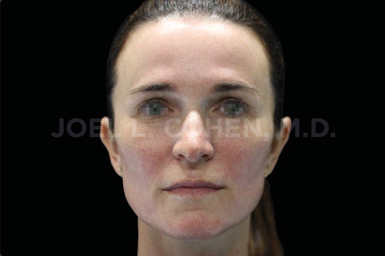 After Emface · Full face