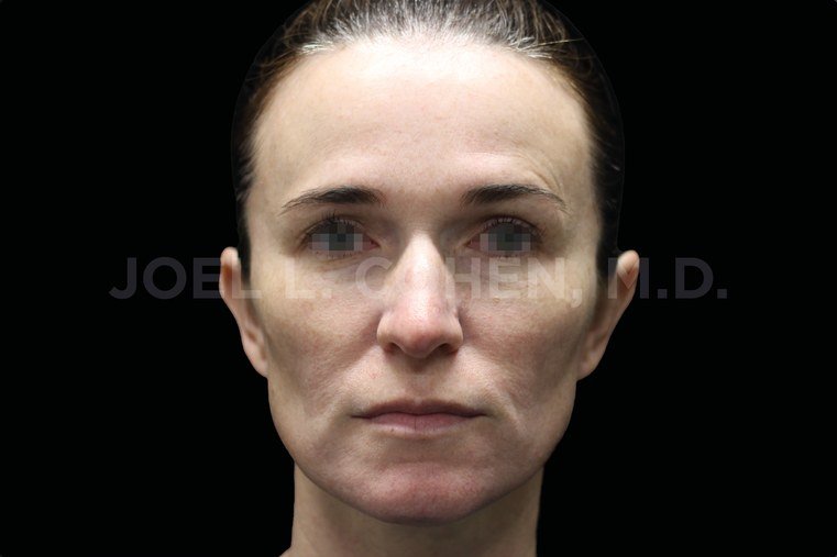 Before Emface · Full face