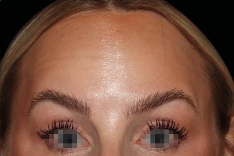 Emface result: Forehead