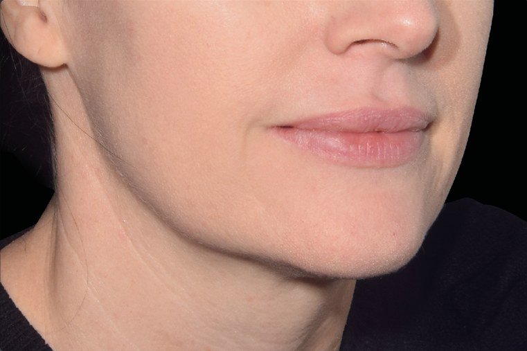After Emface · Jawline