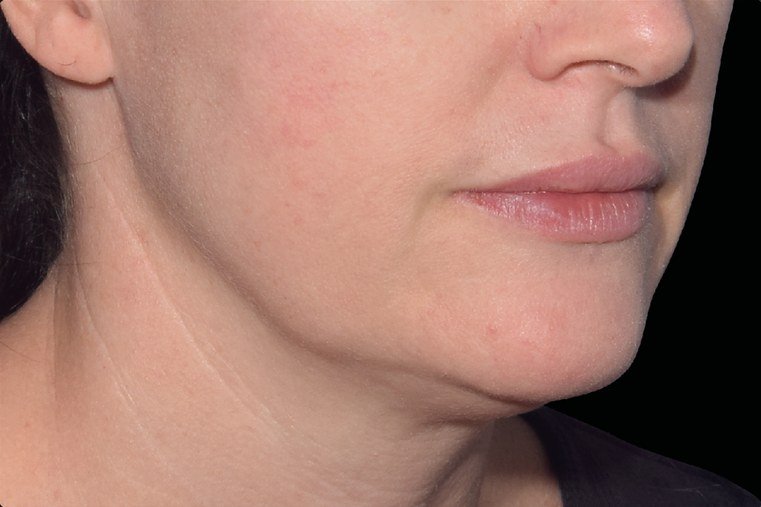 Before Emface · Jawline