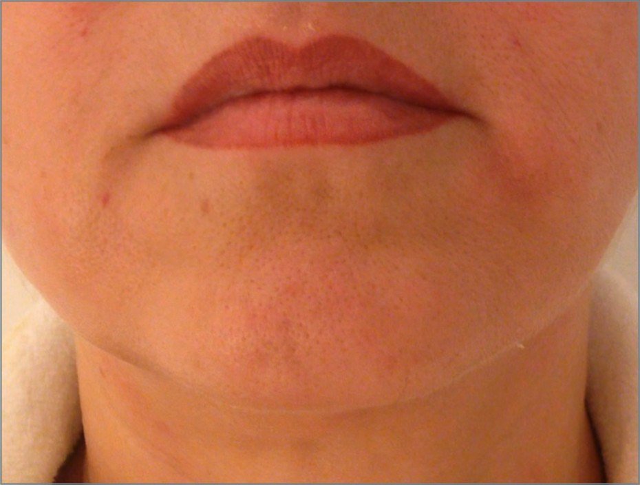 After Endolift X · Chin and lower face