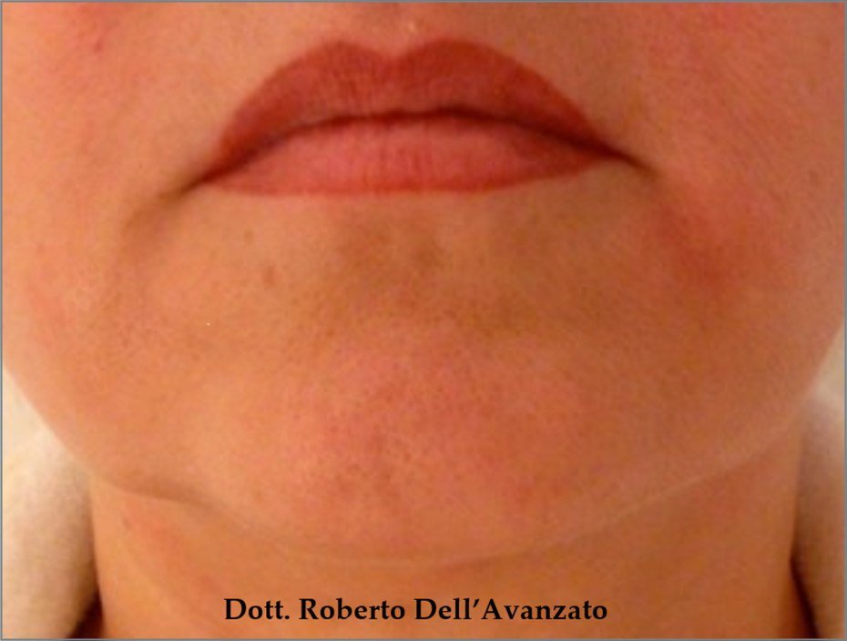 Before Endolift X · Chin and lower face