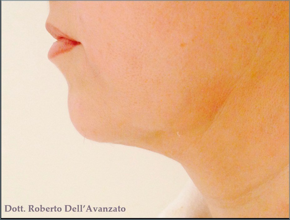 After Endolift X · Jawline, profile