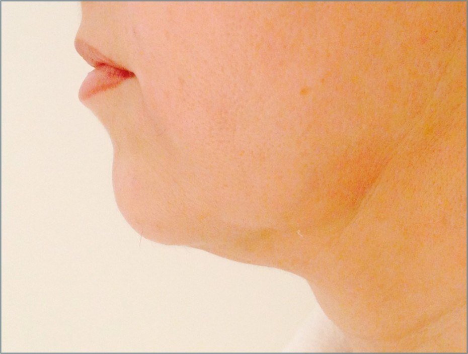 Before Endolift X · Jawline, profile
