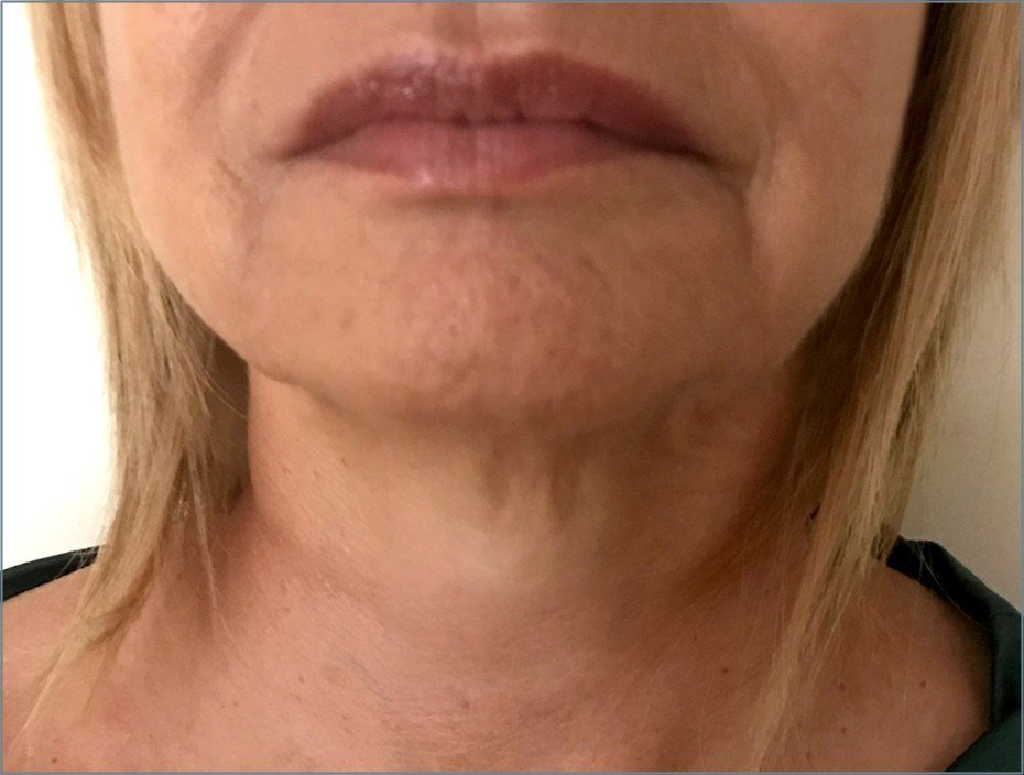 After Endolift X · Neck and jawline