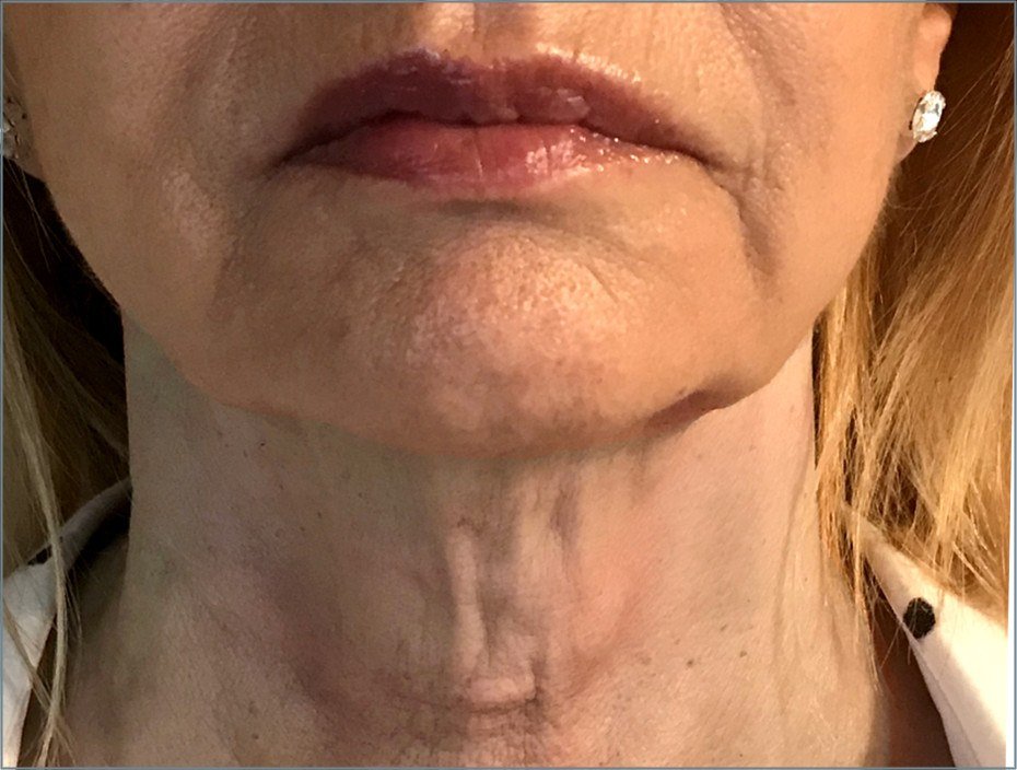 Before Endolift X · Neck and jawline