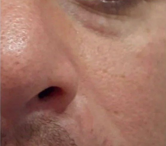 Fotona 4D result: Cheek and under-eye