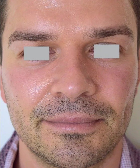 After Fotona 4D · Full face