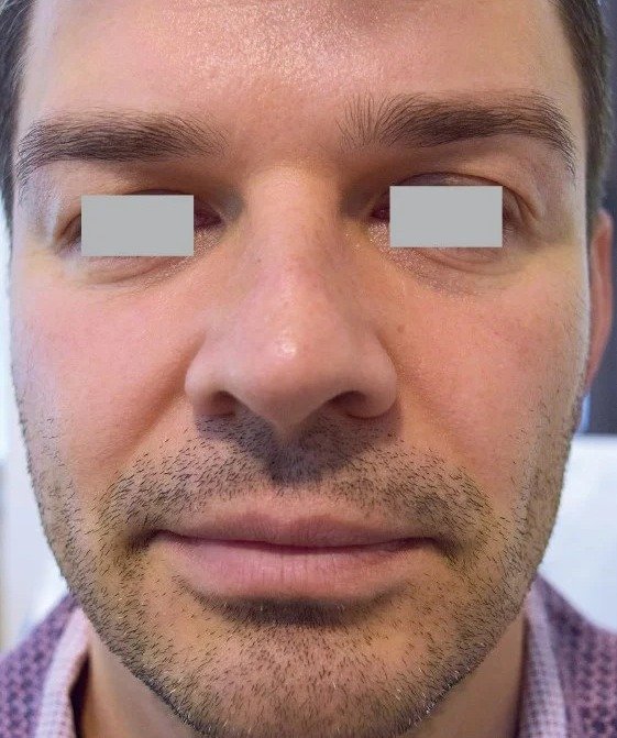 Before Fotona 4D · Full face